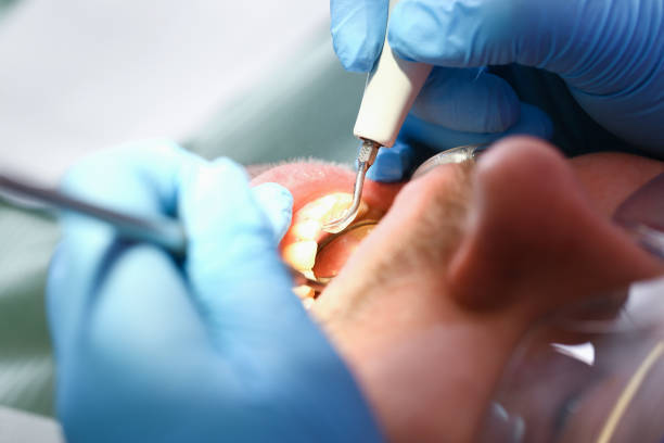 Best Emergency Treatment for Dental Infections or Abscesses in West Hattiesburg, MS